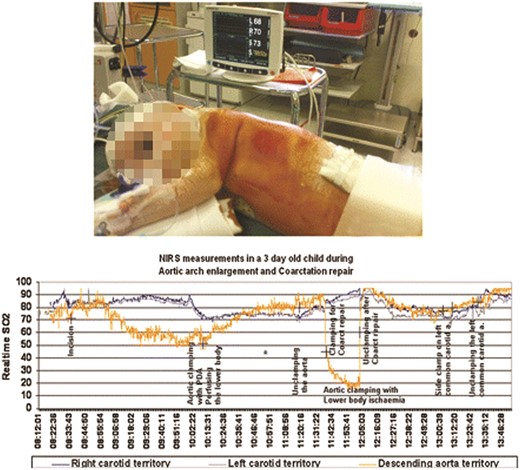 NIRS (intraoperative pad placement—upper panel) showing regional tissue oxygen saturation, in both carotids and descending aortic territories. Note the high lower torso oxygen saturation during non-ischaemic clamping of the aortic isthmus with maintained ductal perfusion (lower panel).