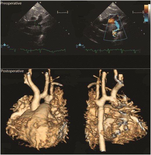 Preoperative echo (upper panels) showing severely hypoplastic arch. Postoperative MRI (lower panel) shows a widened distal arch; the mild hypoplasia in the proximal arch cannot be enlarged with this technique. This child has a corrected gradient of 16 mmHg and is being observed.