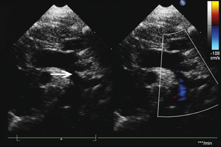 White arrow points at the thickened intimal fold at the lateral margin of the origin of the left common carotid artery, which must be clearly negotiated to be able to perform this technique.