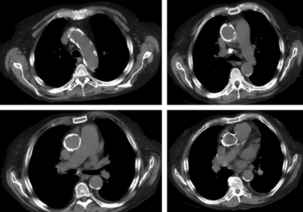 Porcelain aorta or severely atherosclerotic aorta.