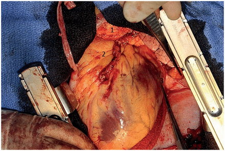 Position of temporary pacing wires (1, right atrium; 2, right ventricular outflow tract; 3, left ventricle, basal region of OM1). Two unipolar wires were attached at each site.