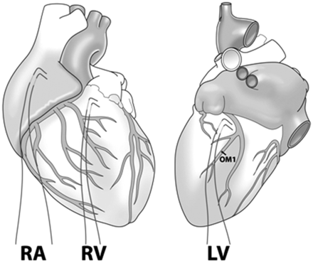 Position of temporary pacing wires (RA: right atrium; RV: right ventricular outflow tract; LV: basal region of OM1).