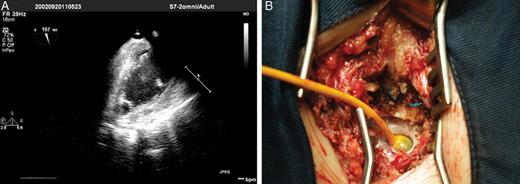 (A) Echocardiogram. A Foley catheter inside the left ventricle cavity. (B) Surgical aspect. Foley catheter in position.