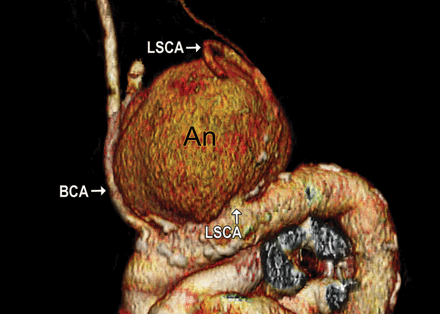 Volume-rendered image of CT (computed tomographic) angiography shows a huge saccular aneurysm measuring 11 × 9 × 8.5 cm located at the origin of the left subclavian artery from the aortic arch. Such a huge aneurysm of the intrathoracic subclavian artery is rare. It also demonstrates the occlusion of the left common carotid artery and the left internal carotid artery. There is 75% stenosis of the left subclavian artery after the branching of the left vertebral artery and 50% stenosis of the right subclavian artery after the branching of the right vertebral artery. After the occurrence of left arteria cerebri media infarction 8 years before the operation, the patient had dysarthria and sensorimotor paralysis, which remained at the time of operation. Furthermore, the patient had progressive stridor due to the compression of the trachea by the aneurysm. In view of severe impairment of venous return due to the compression of the bilateral brachiocephalic veins, collateral venous pathways were identified in the chest wall. The aneurysm had enlarged progressively compared with its size 3 years before the operation (5.5 × 5.4 cm). An: aneurysm; BCA: brachiocephalic artery; LSCA: left subclavian artery.