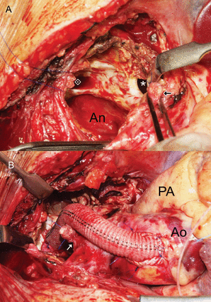 Operative photographs of an aneurysm of the proximal left subclavian artery. (A) Under hypothermic low-flow cardiopulmonary bypass (16°C), the aneurysm was opened after ligation and transection of the occluded left common carotid artery. (B) After closure of the entry of the aneurysm with running sutures under circulatory arrest, a prosthetic bypass graft (woven double-velour vascular graft, 12 mm in diameter) was placed from the ascending aorta to the left subclavian artery at the exit of the aneurysm. Asterisk denotes the entry of the aneurysm. denotes the exit of the aneurysm. Black and white arrows indicate the cut-end of the left common carotid artery. An: cavity of the aneurysm; Ao: ascending aorta; PA: main pulmonary artery.