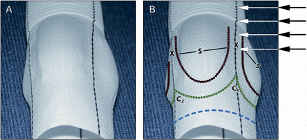 New sinus prosthesis (Uni-Graft® W SINUS, B. Braun Melsungen AG, Germany). (A) Original and (B) prepared as follows: Blue dotted line: resection line of the proximal prosthesis 3–4 mm apart from the nadir of the sinuses. Green dotted line: proximal suture line, in the inter-leaflet triangle between the right and non-coronary sinus (C1), the proximal suture line has a more scalloped shape than between the right- and left-coronary sinus (C2); C2 is slightly incised if the patient's inter-leaflet triangle is prominent. S: sinuses of Valsalva. X: commissural pillar between sinuses is straight in line with the proximal and distal circular tube and allows for the attachment of the patient's commissures at any height of the graft (arrows), which may even be extended into the tube graft if necessary. Black dotted line: suture line for reimplantation of the aortic valve.