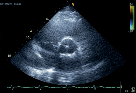 Transthoracic echocardiography of the new sinus prosthesis. Short axis view (B-mode) of the neoaortic root 22 months after implantation (same patient as in Figure 4) showing the normal configuration of the root.