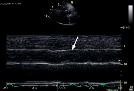 Transthoracic echocardiography of the new sinus prosthesis. Long axis view (M-mode) of the neoaortic root 22 months after implantation showing no contact of the aortic cusps with the aortic wall (arrow).
