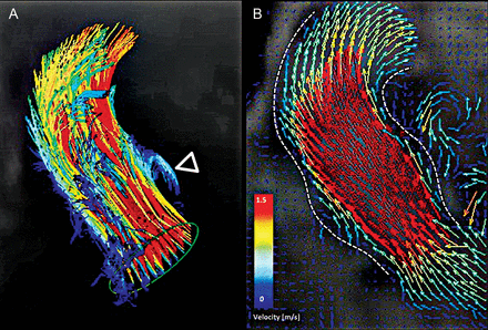 4D flow of new sinus prosthesis. Flow-sensitive time-resolved ‘4D’ magnetic resonance imaging with flow sensitivity in all three directions performed in one patient with a tricuspid valve. Colour-coding was performed with respect to the absolute measured velocities. 3D particle traces, resembling virtual massless particles emitted from the left ventricular outflow tract (A), and vector graphs (B) at a systolic time frame, depict the acquired flow patterns. Dashed white lines enhance the outline of the vessel. Four main features are represented: a systolic vortex that is filling the left-coronary sinus in A (open arrowhead) and laminar-like flow gently filling the root (B). Visualization performed with GTFlow v1.6.6, GyroTools, Zurich, Switzerland.