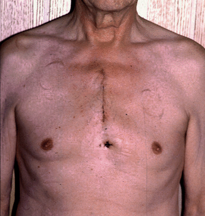 Partial upper sternotomy.