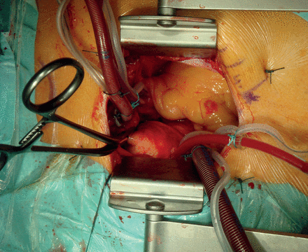 Central cannulation for CPB.