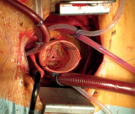Adequate exposure of surgical field.