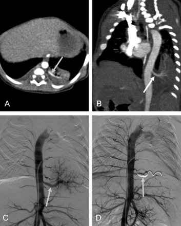 A 4-day-old girl with pulmonary sequestration in the left lower lobe. (A) Axial multiplanar reconstruction image demonstrates a homogenous, solid mass in the posterobasal segment of the left lower lobe supplied by an aberrant systemic artery (arrow) arising from the aorta. (B) Coronal maximum intensity projection exhibits an aberrant systemic artery (arrow) originating from the descending aorta and supplying the mass in the left lower lobe. (C) Pre-embolization aortography shows the aberrant artery (arrow) branching from the descending aorta. (D) Postembolization angiography confirms the complete occlusion of the aberrant artery with coils (arrow).