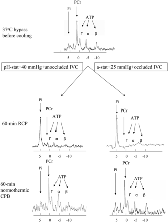 Representative MR spectra from the two groups: right, retrograde cerebral perfusion with conventional protocol (alpha-stat, 25-mmHg perfusion pressure, occluded inferior vena cava); left, retrograde cerebral perfusion with modified protocol (pH-stat, 40-mmHg perfusion pressure and open inferior vena cava).
