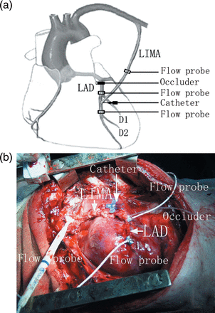 (a) A schematic layout that demonstrates the position of the three flow probes on LIMA and LAD, the standard occluder on LAD and the catheter through LIMA. (b) A real photograph of the experimental swine model of CABG.