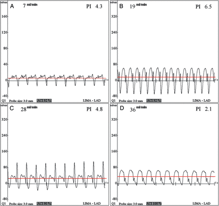 LIMA flow waveforms with the proximal LAD at four different degrees of stenosis: 0 (A); 50 (B); 75 (C); and 100% (D). Typical biphasic velocity waveforms were noted at 0 (patent) and 50% stenosis. The upper lines represent the mean flow of LIMA.