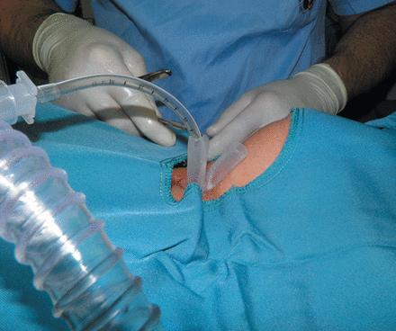 T-tube insertion procedure.
