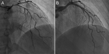 Coronarography performed in a tertiary hospital showed diffuse and tight left coronary stenosis with left main involvement (A) and a normal right coronary artery. The study performed 48 h later under oral vasodilator therapy (isosorbide mononitrate 30 mg id and Nifedipine 10 mg 4id) showed total resolution of the left coronary stenosis (B).