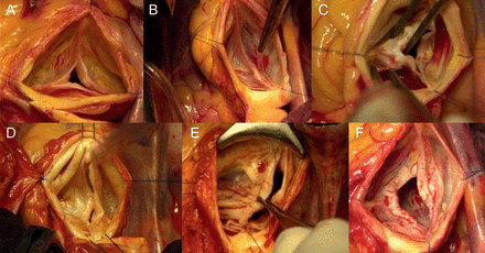 Showing different aortic valve phenotypes: (A) normal tricuspid, (B) normal bicuspid, (C) stenosed bicuspid, (D and E) regurgitant bicuspid with prolapsing cusp and (F) regurgitant bicuspid with restrictive cusp.