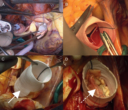 (A) Bioprosthetic aortic valve replacement, (B) modified Bentall procedure (with a Dacron graft sutured to a bioprosthesis; Bio-Bentall), (C) remodelling procedure (white arrow showing tongue of graft to fit scalloped sinus) and (D) reimplantation procedure (note dotted white arrow showing resuspension of cusp leaflets in this specimen).