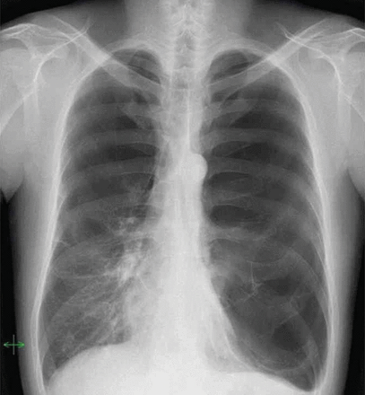 Chest radiography revealed bilateral giant emphysematous bullae. In particular, the left giant emphysematous bulla occupied the entire left hemithorax.