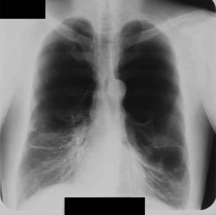 Chest radiograph taken 4 years previously showed that the left lung was compressed by a giant emphysematous bulla, but it was still recognizable.