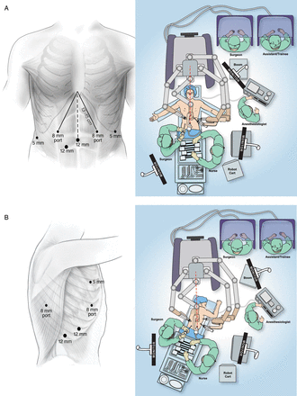 Abdominal phase room setup and port placement (A) and thoracic phase room setup and port placement (B).