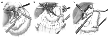 Retrogastric and left gastric vascular pedicle dissection (A), greater gastric curve dissection (B) and gastric conduit formation (C).