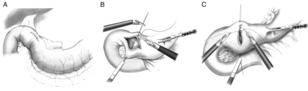 (A–C) Pyloroplasty.
