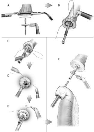Placement of stapler anvil (A), purse-string sutures (B–E) and placement of end-to-end anastomotic stapler within gastric conduit (F).