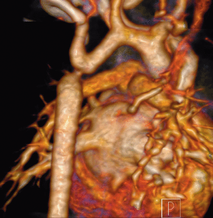 A view from the back: the ductal aneurysm has developed to coarctation of the aorta.