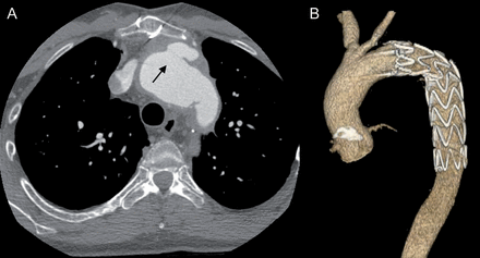 A 39-year old patient developed a leak of the distal anastomis (arrow) 3 days after homograft operation (A). This was treated with a endovascular stent graft implantation (B). The left sublclavian artery was not reinserated during the homograft implantation.