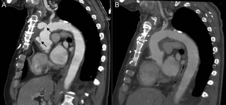 A 64-year old patient needed re-homograft replacement of the aortic root, ascending aorta and aortic arch due to homograft degeneration (arrows) 2 years after surgery (A). The initial follow-up CT scan was without pathological findings (B). Again a homograft was implanted since an infected component could not be excluded.