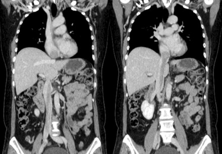 Multi-detector CT showed the tumour arising from the right internal iliac vein and extending into the right atrium through the inferior vena cava.