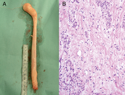 (A) The 43 cm-long white tumour removed from the right atrium. (B) Histology image of the excised specimen showed benign smooth muscle cells and stroma cells with myometrial vessels (haematoxylin and eosin stains, original magnification ×100).