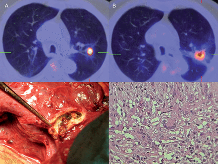 (A) FDG-PET/CT before tumour resection. (B) Hypermetabolic foci in the upper lobe of the left lung in the resected area 6 months after surgery. (C) Fibrotic tissue surrounding the BioGlue® area. (D) Histological section of the fibrous scar tissue showing a combined infiltration composed of polymorphonuclear neutrophils, eosinophils, histiocytes, plasma cells and foreign body multinucleated giant cells.