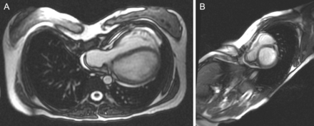 (A and B) Preoperative axial and sagittal CMR imaging views of pectus excavatum. The right ventricle and right and left atria are markedly compressed and ‘entrapped’ between the sternum and the vertebral column.