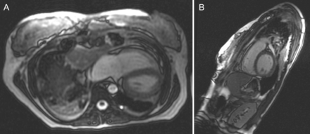(A and B) Postoperative axial and sagittal CRMI views of pectus excavatum. There is relief of compression of both the right ventricle and the right atrium and (less well shown in B) left atrium with restoration of a more normal antero-posterior dimension.