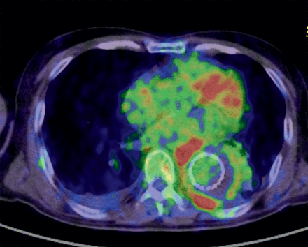 Image of graft infection. High uptake lesions were seen around the stent graft in the descending aorta. The SUVmax was 18. This patient also had abdominal grafts; however, only the graft of the descending aorta was re-replaced in the reoperation because the uptake around the abdominal graft was low. Gram-positive cocci were identified in the infected graft. Note that the uptake in the heart was not abnormal.