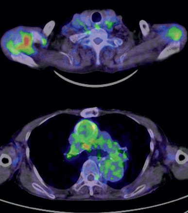 Images of a patient without graft infection. This patient had previously undergone ascending aorta replacement and suffered from a persistent fever. The SUVmax around the graft was 3.2, and the uptake was not high. Instead, a high uptake was seen in the right shoulder joint. Multiple arthritis (elderly-onset rheumatoid arthritis) was confirmed to be the cause of the fever.