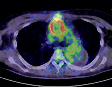 Image of graft infection. High uptake lesions were seen around the ascending aorta graft. The SUVmax was 10.9. Note that the uptake in the thrombosed false lumen in the descending aorta was low.
