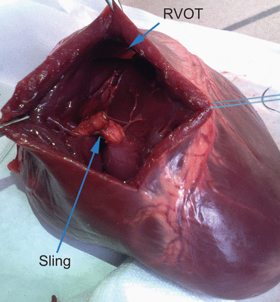 Porcine heart—sling approximating papillary muscles of the tricuspid valve. Note the non-compromised right ventricular outflow tract (RVOT).