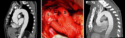 (left) Preoperative sagittal reconstruction of contrast-enhanced computed tomography scan (angio-CT) showing aneurysm of the ascending aorta and dilatation of the atherosclerotic aortic arch in 73-year-old male. Even if pathology of the descending aorta (atherosclerosis and mild-to-moderate dilatation) did not demand any procedure at time of surgery, necessity of such procedure at later date cannot be ruled out. (middle) Intraoperative photograph after aortic root repair and proximal aortic replacement depicting the moving of supra-aortic arteries away from distal anastomosis between arch graft and descending aorta. (right) Postoperative angio-CT of the same patient. Proximalward moving of supra-aortic arteries enables safe anchoring of the stent graft in arch prosthesis should endografting of the descending aorta become necessary in future. I: innominate artery; C: left common carotid artery; S: left subclavian artery. For technical details see text.