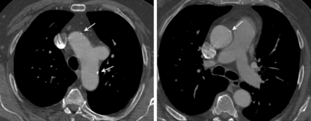 Preoperative axial images of contrast-enhanced computed tomography scan (angio-CT) showing saccular aneurysm of the aortic arch (left) and mild dilatation of the atherosclerotic ascending aorta (right) in 72-year-old male. Arrows indicate calcifications in both aortic arch and ascending aorta.