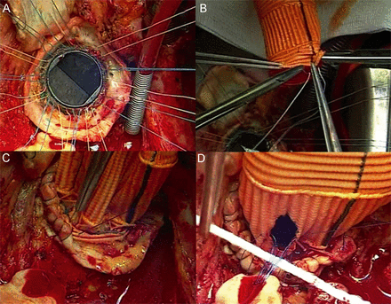 (A) Horizontal Teflon felt pledgeted 2-0 mattress sutures were placed from outside the aortic annulus to the sewing ring of the previously implanted aortic prosthesis and then (B) to the Dacron conduit. The graft was parachuted and sutures tied. (C) The 4-mm remnant of the aortic wall was sutured to the proximal end of the Dacron graft using a 4/0 polypropylene running suture to improve haemostasis. (D) The left and right coronary ostia were re-implanted using a 5/0 polypropylene running suture.