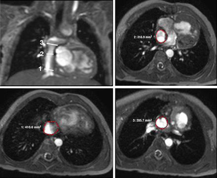 Sites of cross-sectional area measurement: (1) above the junction between the inferior vena cava and the intra-atrial lateral tunnel, (2) at the fenestration and (3) below the junction between the intra-atrial lateral tunnel and the pulmonary arteries.