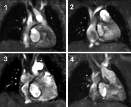 Morphology of the intra-atrial lateral tunnel: (1) tunnel with a tubular shape, (2–4) patients with deviation from a straight tubular tunnel.