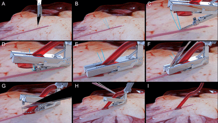 (A–C) Graft and target vessel preparation; (D–F) deployment of the C-Port device; (G–I) removal of the C-Port device.