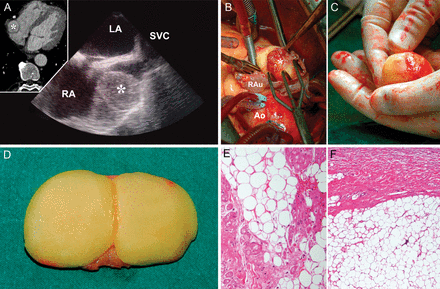 (A) Transoesophageal echocardiography and 64-slice multidetector computed tomography angiogram (small window) showing the lipoma as a 30 × 35-mm capsulated mass attached to the lateral wall of the right atrium. (B) Surgical view: a lipoma bulging from the right atrium as a spherical mass. (C) A lipoma in the surgeon's hand. (D) Lipoma divided after removal. (E and F) Histological section at ×150 and ×200 magnification, respectively, showing adipose tissue intermixed with myocardium (haematoxylin and eosin stain). Asterisks denote the lipoma; RA: right atrium; LA: left atrium; SVC: superior vena cava; Ao: aorta; RAu: right auricle.