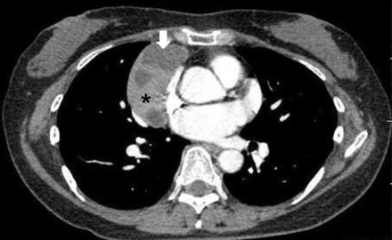 Contrast-enhanced chest CT findings of a Masaoka Stage I and WHO Type B2 thymoma in a 56-year old female patient. This is the CT scan of a representative case with a cystic or necrotic component in the mediastinal tumour. CT Hounsfield units of this area (arrow) and solid component (star) are 10 and 80, respectively. The capsule of this cystic portion was injured during VATS-Tx. This patient has had no relapse for 4 years after the operation.